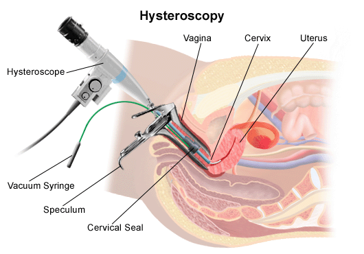 Histeroskopi nedir, nasıl yapılır, avantajları ve riskleri nedir?